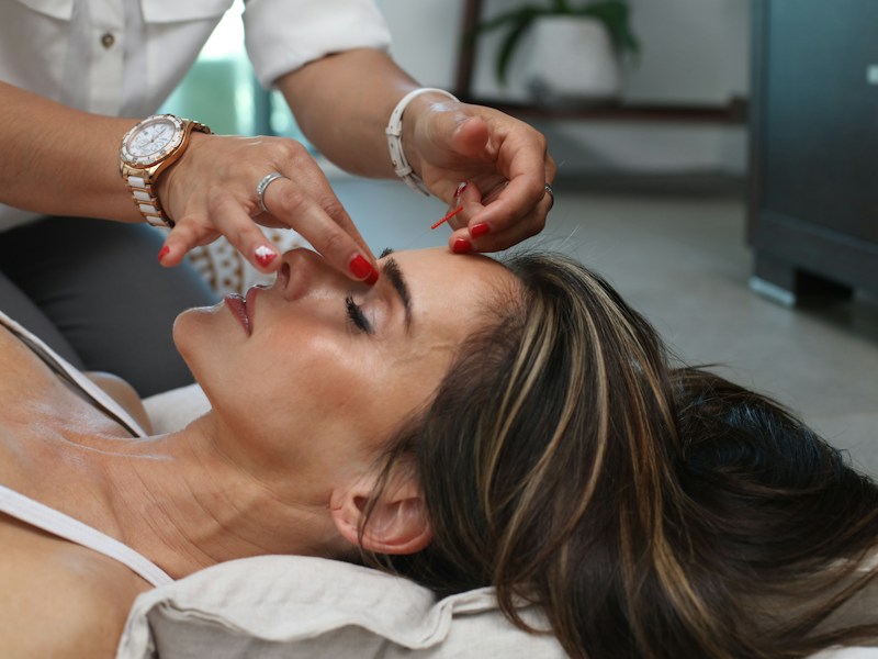Deep acne scarring softened dramatically across a year of patient, properly-spaced needling.